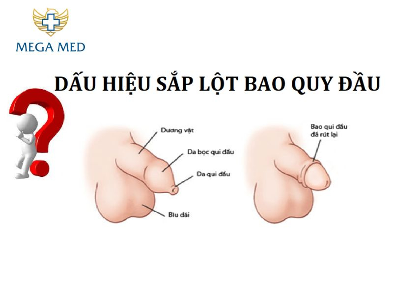 Dấu hiệu sắp lột bao quy đầu